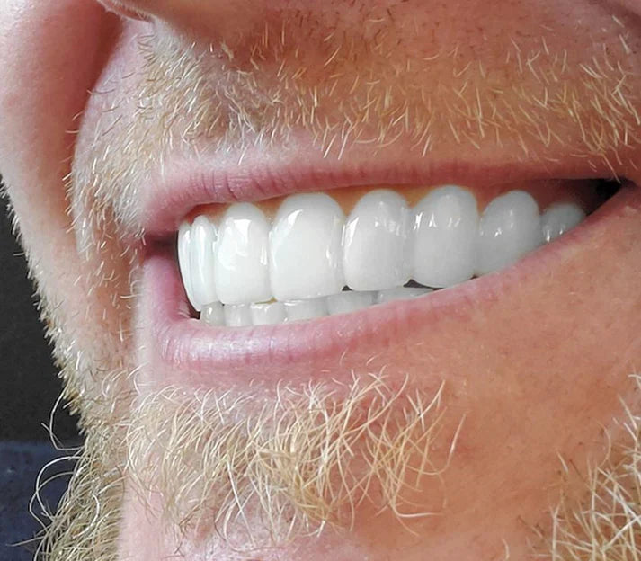 LENTE CERÁMICA DENTAL - Lumineo™